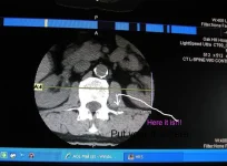 Transverse fracture.webp